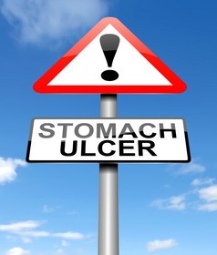 插图描绘标志与胃溃疡概念
