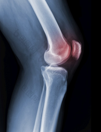 x射线膝盖射线照片显示状态受伤