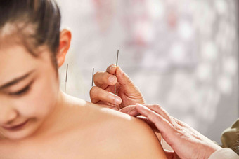 年轻女人的肩膀接受针灸治治病高端素材