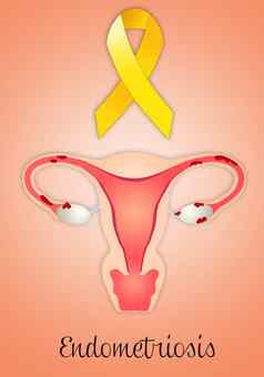 子宫内膜异位子宫黄色的丝带