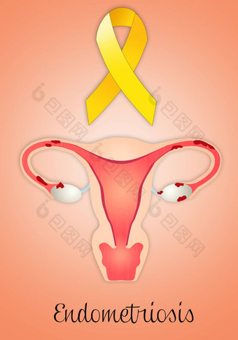 子宫内膜异位子宫黄色的丝带