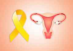 子宫子宫内膜异位黄色的丝带