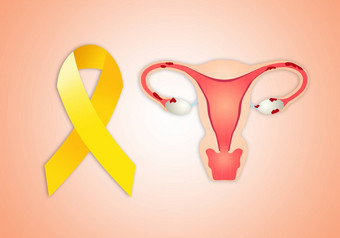 子宫子宫内膜异位黄色的丝带