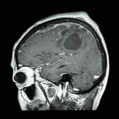 电影核磁共振大脑大脑肿瘤矢状面飞机一边视图横向视图医疗健康护理科学背景