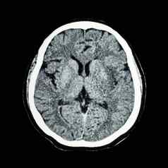 扫描大脑显示正常的人类大脑猫扫描