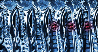 颈脊椎病阀瓣椎间盘突出核磁共振颈脊柱显示颈脊椎病阀瓣椎间盘突出压缩脊髓绳脊髓病