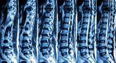 核磁共振腰椎胸脊柱显示骨折胸脊柱压缩脊髓绳脊髓病