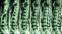 核磁共振腰椎胸脊柱显示骨折胸脊柱压缩脊髓绳脊髓病