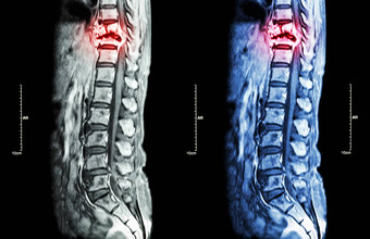 脊柱转移癌症传播胸脊柱核磁共振胸腰椎脊柱显示胸脊柱转移压缩脊髓绳脊髓病矢状面飞机
