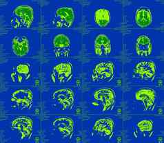 磁共振成像大脑可见异常