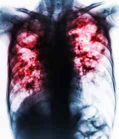肺肺结核电影胸部x射线显示纤维化腔间质渗透肺由于分枝杆菌肺结核感染