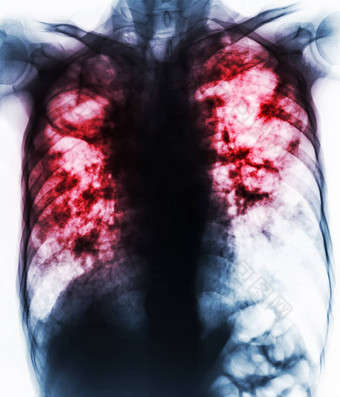 肺肺<strong>结核</strong>电影胸部x射线显示纤维化腔间质渗透肺由于分枝杆菌肺<strong>结核</strong>感染