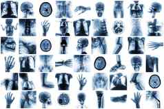 x射线多个部分人类医疗条件疾病