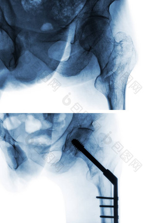 转子间<strong>骨折</strong>股骨大腿骨x射线臀部比较手术上图像手术较低的图像病人操作插入髓内指甲