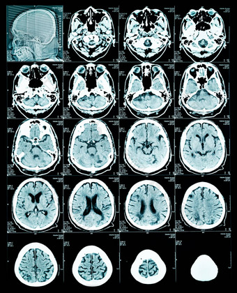 核磁共振扫描图像大脑