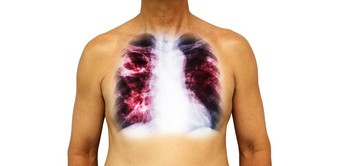 <strong>肺肺</strong>结核人类胸部x射线显示腔上<strong>肺</strong>间质渗透<strong>肺</strong>由于感染孤立的背景