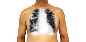 <strong>肺肺</strong>结核人类胸部x射线显示腔上<strong>肺</strong>间质渗透<strong>肺</strong>由于感染孤立的背景