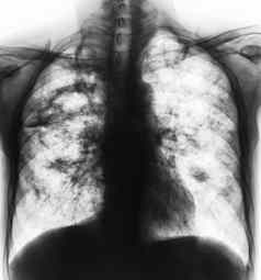 肺肺结核电影x射线胸部显示腔肺间质渗透肺由于感染