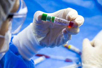 艾滋病毒艾滋病感染测试医生脸手持有管血蓝色的背景