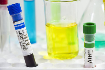 艾滋病毒艾滋病感染血测试样本诊断实验室化学液体元素