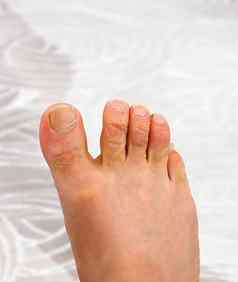 过敏皮肤皮疹脚趾真菌疾病脚趾