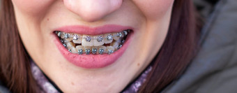 牙套女孩的牙齿宏照片牙齿特写镜头嘴唇