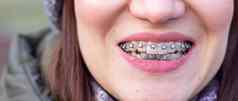 牙套女孩的牙齿宏照片牙齿特写镜头嘴唇