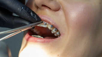 女人牙医的任命取代拱门牙套