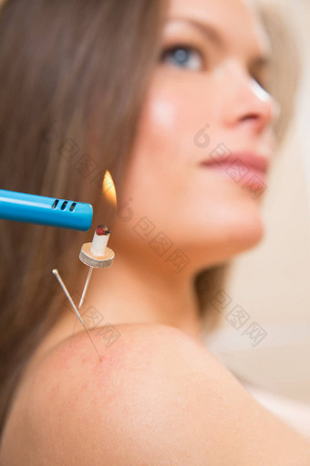 艾灸acupunture针热女人