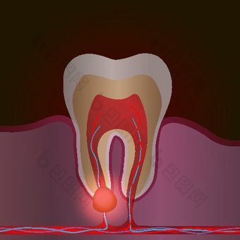 牙科疾病疼痛炎症医疗插图牙根炎症牙根囊肿牙髓炎图片