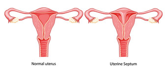集子宫隔有隔膜的子宫正常的疾病女生殖系统图前面视图图片