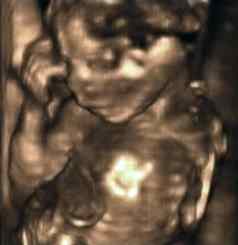 超声分析月胎儿