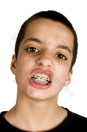 十几岁的显示牙科牙套