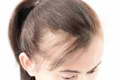 女人头发损失问题健康护理洗发水情郎
