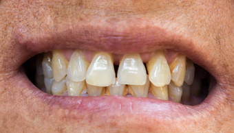 特写镜头女人牙齿问题牙龈凶悍的人健康的