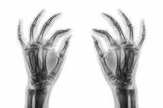 x射线正常的人类手白色背景斜视图