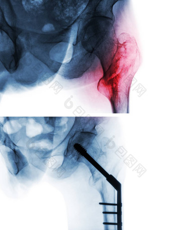 转子间<strong>骨折</strong>股骨大腿骨x射线臀部比较手术上图像手术较低的图像病人操作插入髓内指甲