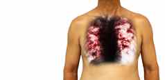 肺肺结核人类胸部x射线显示腔肺间质渗透肺由于感染孤立的背景空白区域左一边