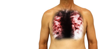 <strong>肺肺</strong>结核人类胸部x射线显示腔<strong>肺</strong>间质渗透<strong>肺</strong>由于感染孤立的背景空白区域左一边