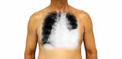 肺癌症人类胸部x射线显示胸膜积液左肺由于肺癌症
