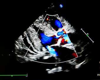 流颜色超声<strong>心动图</strong>