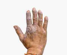 特写镜头牛皮癣手农民孤立的白色背景皮肤病学皮肤疾病牛皮癣手指畸形