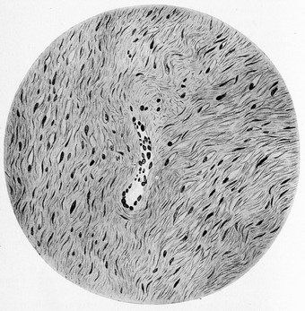 软fibroma古董雕刻