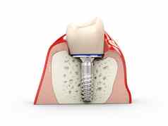 人类牙齿牙科植入物插图