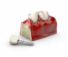 插图牙牙科植入物模型