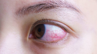 红色的<strong>充血眼睛</strong>女人恼怒的受感染的结膜炎