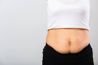 女人显示拉伸马克宽松的较低的腹部皮肤脂肪工程