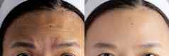 额头皱纹问题图片相比效果治疗额头皱纹皮肤问题女人解决皮肤问题皮肤结果