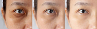图片相比效果治疗眼睛问题黑暗圈虚胖皱纹眶周的治疗解决皮肤问题皮肤