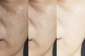 图片<strong>相比</strong>效果治疗皮肤问题雀斑孔隙无趣的皮肤皱纹治疗解决皮肤问题皮肤结果